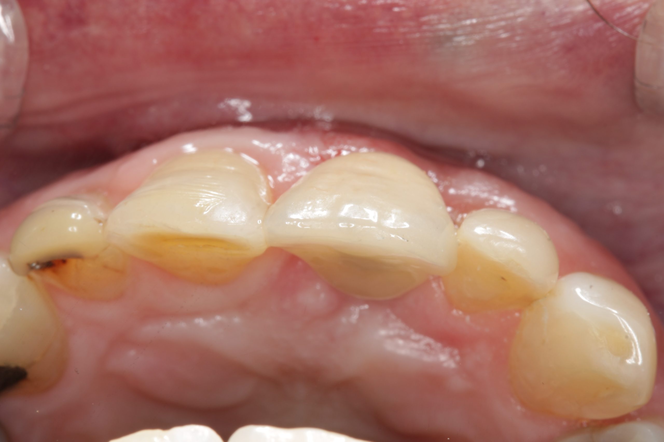 After Occlusal