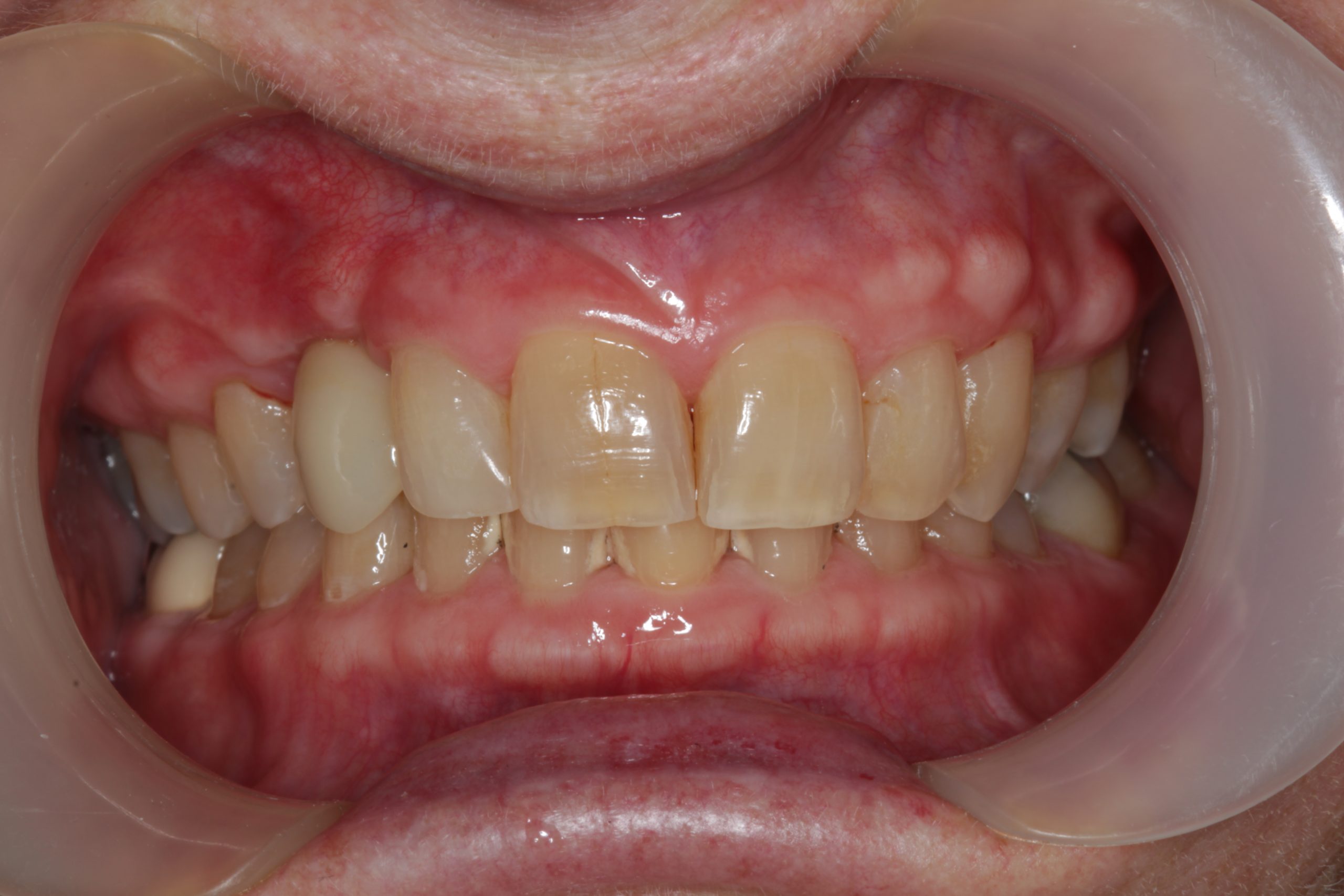 After frontal retracted