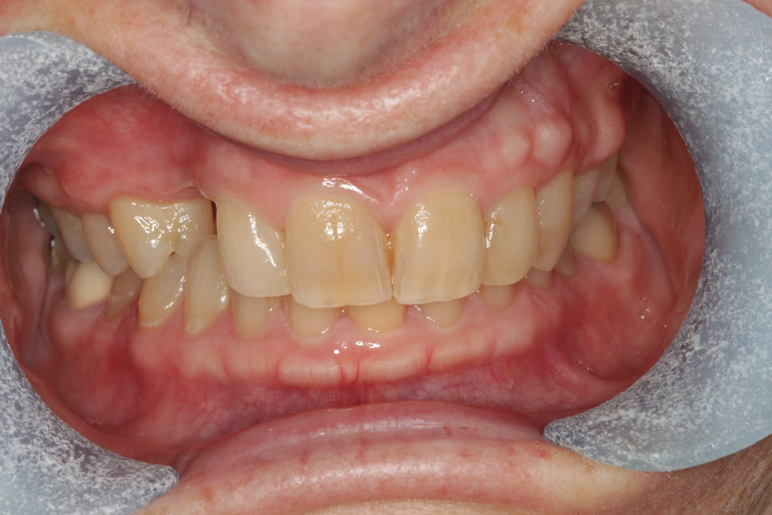 Before frontal retracted